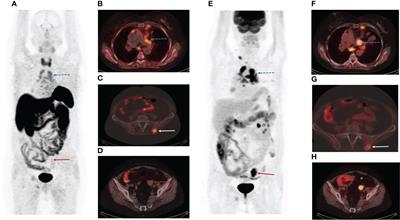 Dual-tracer PET/CT imaging to determine tumor heterogeneity in a patient with metastatic ACTH-secreting neuroendocrine neoplasm: A case report and literature review